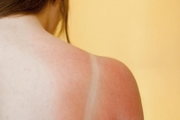 Καλοκαίρι, θάλασσα, ηλιοθεραπεία: Πως θα καταπραΰνετε το καμένο δέρμα;